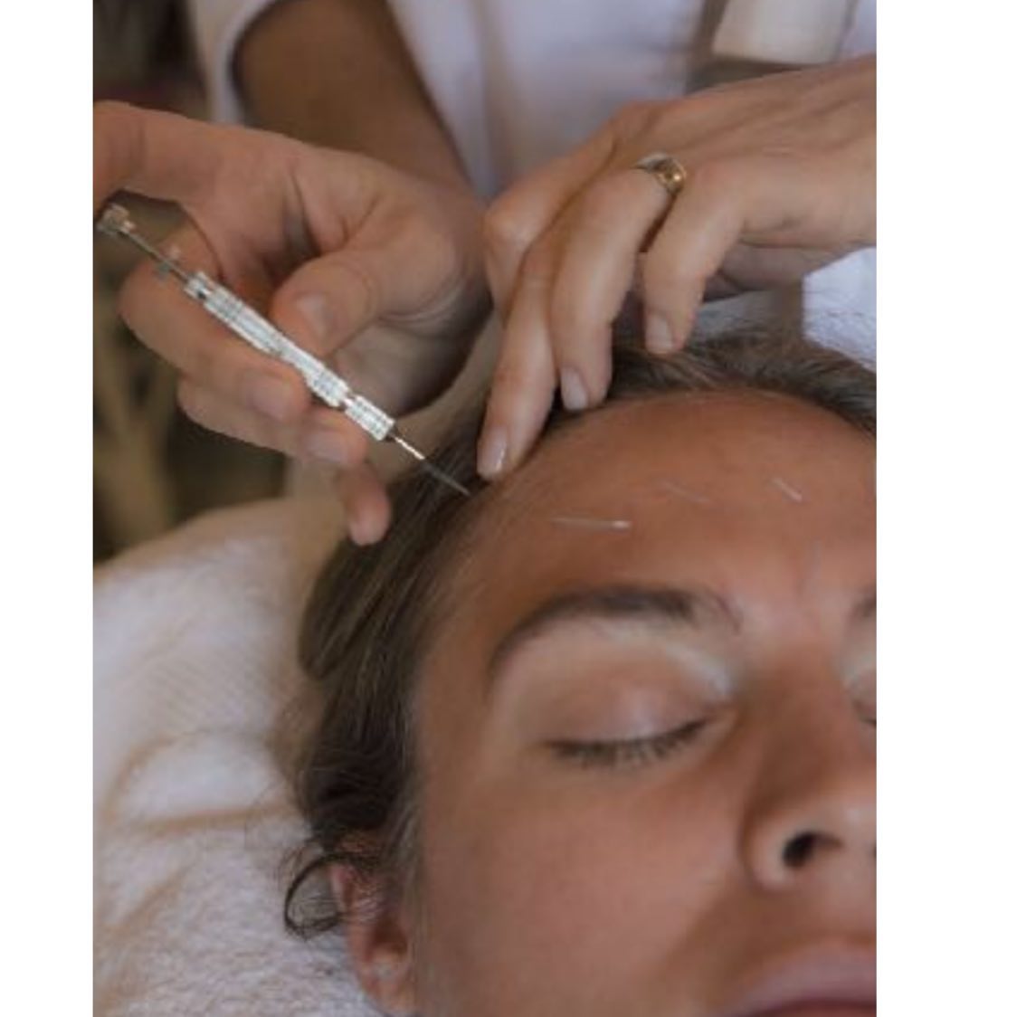 Lifting sin cirugía en Amarilis Neves: rejuvenece tu rostro de forma natural y segura